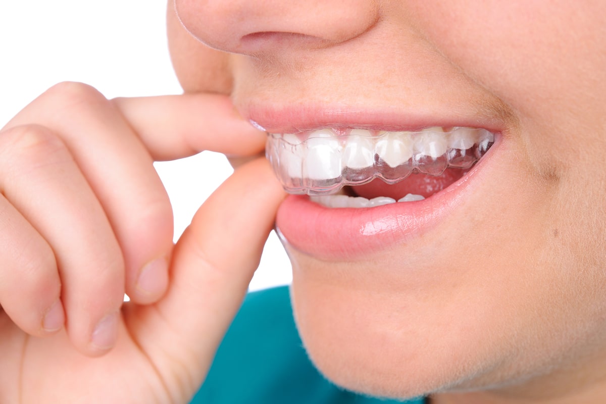 How Long Does Invisalign Take (2)